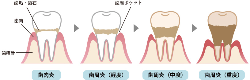 歯周病の進行症状